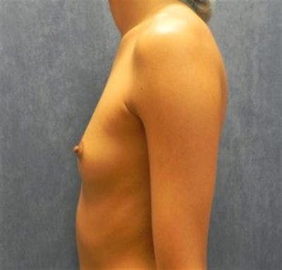 Breast Augmentation Before & After Gallery - Patient 388835 - Image 1