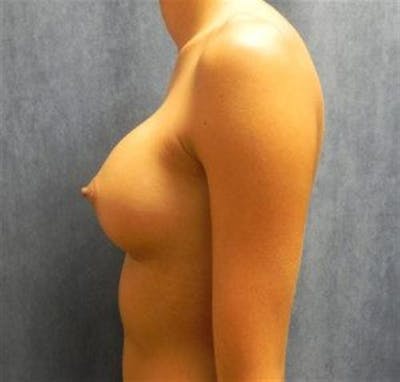 Breast Augmentation Before & After Gallery - Patient 388835 - Image 2