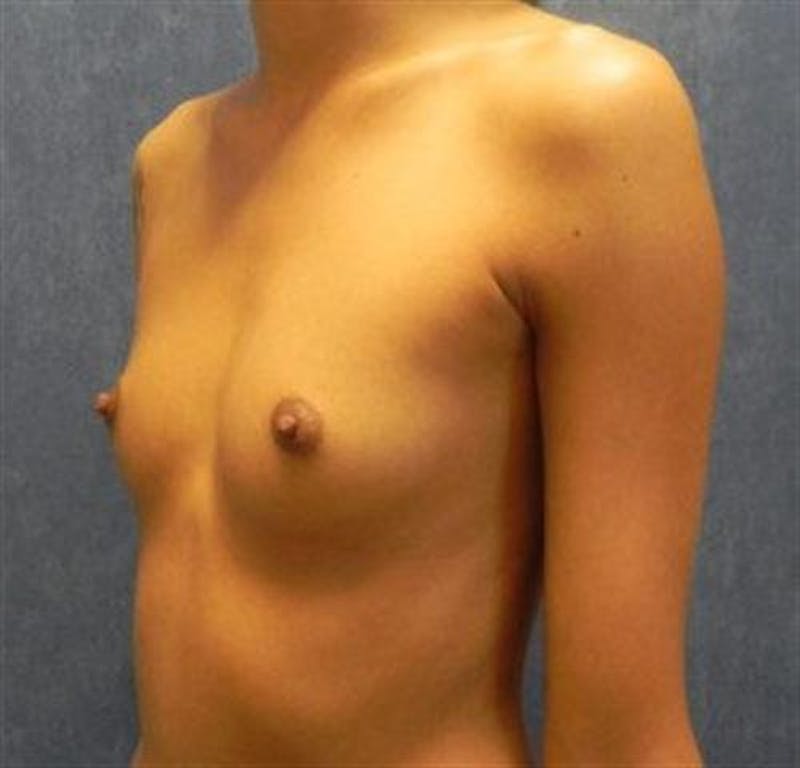 Breast Augmentation Before & After Gallery - Patient 388835 - Image 3