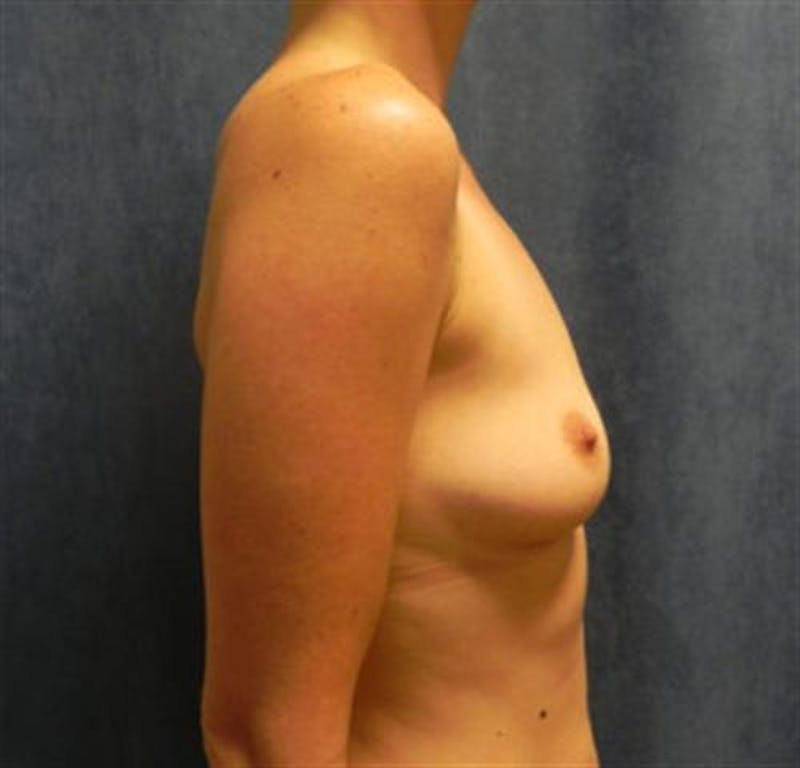 Breast Augmentation Before & After Gallery - Patient 154391 - Image 3