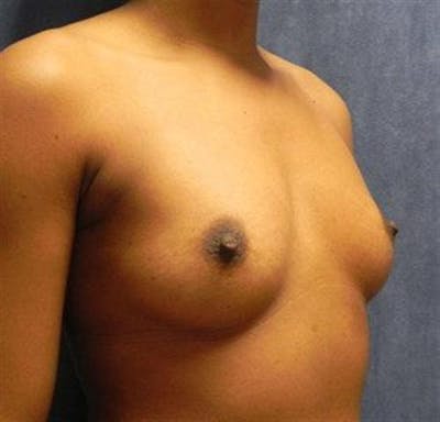 Breast Augmentation Before & After Gallery - Patient 387945 - Image 1