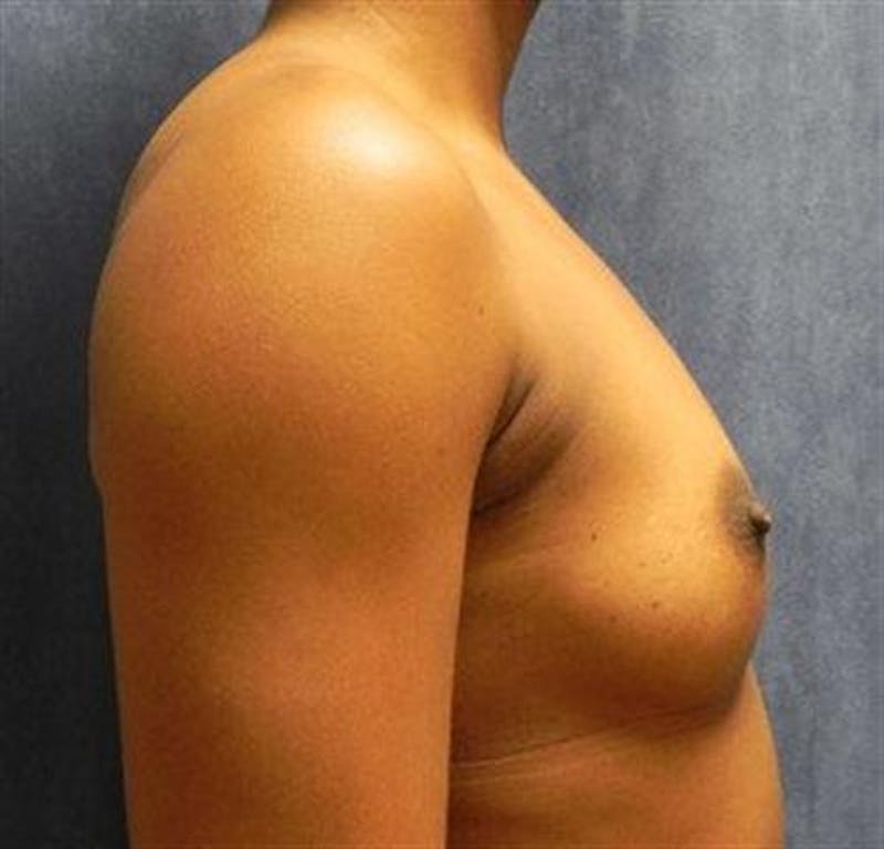 Breast Augmentation Before & After Gallery - Patient 387945 - Image 3