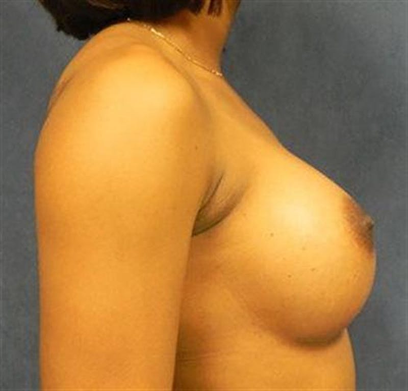 Breast Augmentation Before & After Gallery - Patient 387945 - Image 4