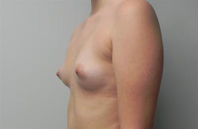Breast Augmentation Before & After Gallery - Patient 110898 - Image 1