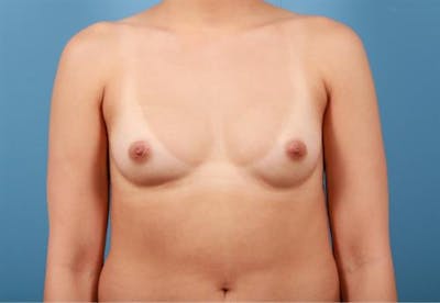Breast Augmentation Before & After Gallery - Patient 188602 - Image 1
