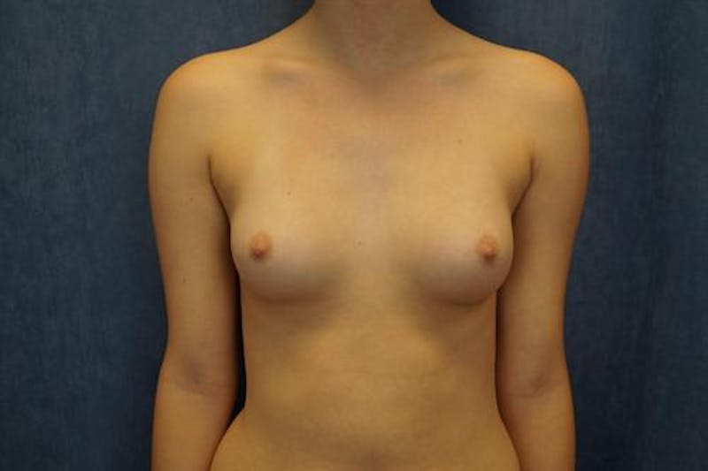 Breast Augmentation Before & After Gallery - Patient 225781 - Image 1