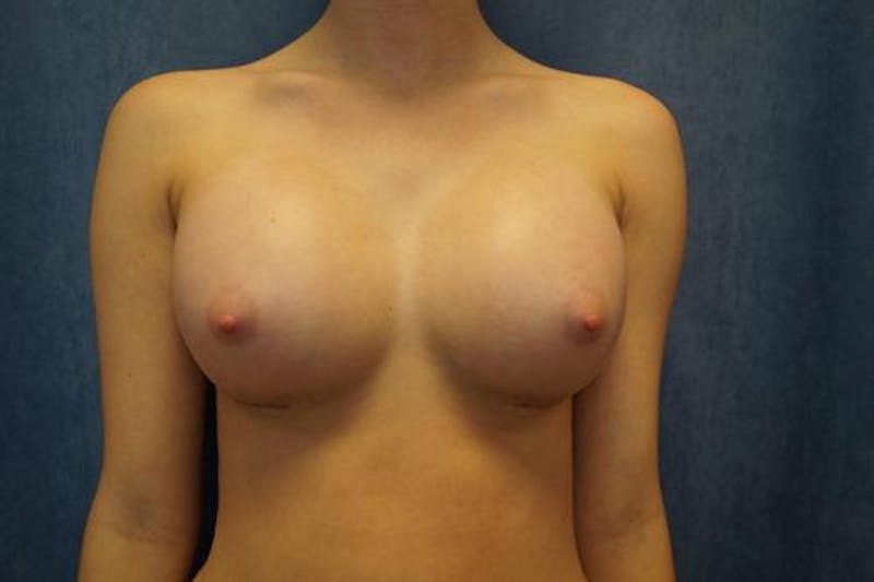 Breast Augmentation Before & After Gallery - Patient 225781 - Image 2