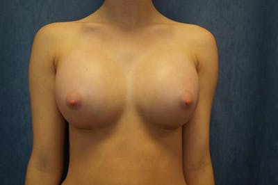 Breast Augmentation Before & After Gallery - Patient 225781 - Image 2