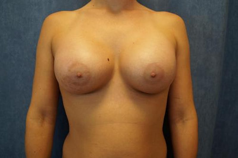 Breast Augmentation Before & After Gallery - Patient 176856 - Image 2