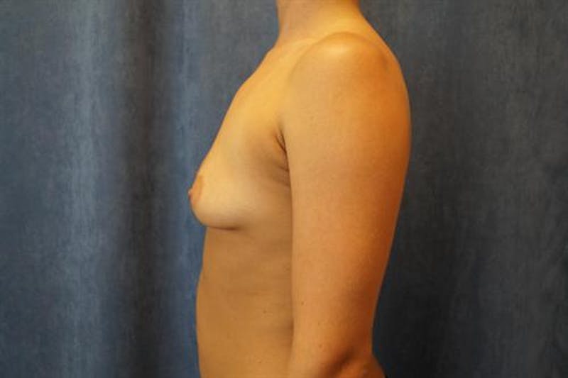Breast Augmentation Before & After Gallery - Patient 176856 - Image 5