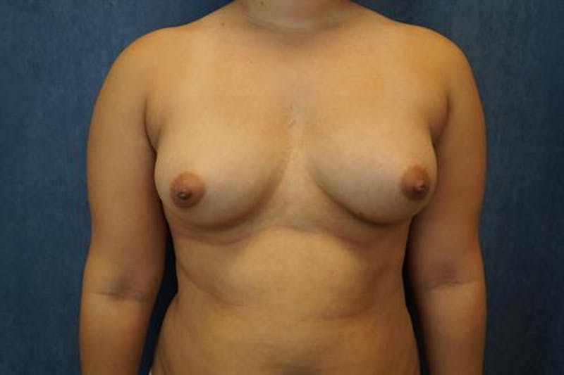 Breast Augmentation Before & After Gallery - Patient 389878 - Image 1
