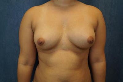Breast Augmentation Before & After Gallery - Patient 389878 - Image 1