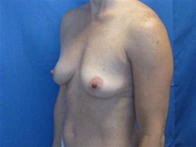 Breast Augmentation Before & After Gallery - Patient 126798 - Image 1