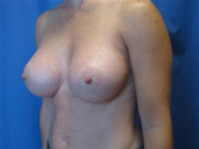 Breast Augmentation Before & After Gallery - Patient 126798 - Image 2