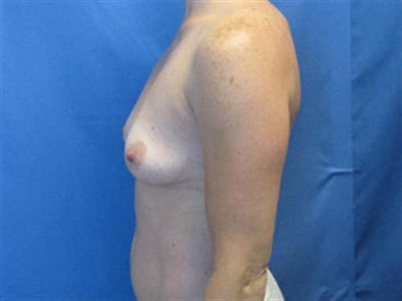 Breast Augmentation Before & After Gallery - Patient 126798 - Image 3