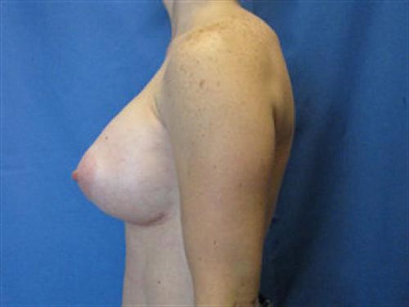 Breast Augmentation Before & After Gallery - Patient 126798 - Image 4