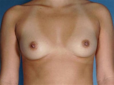 Breast Augmentation Before & After Gallery - Patient 344999 - Image 1