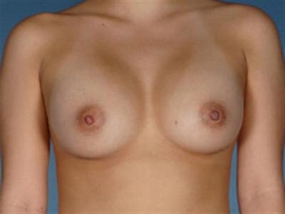 Breast Augmentation Before & After Gallery - Patient 344999 - Image 2