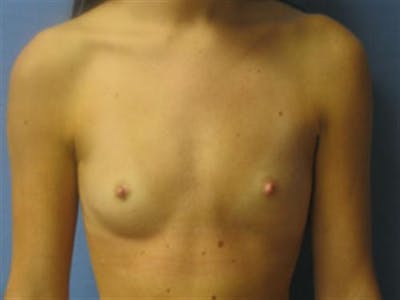Breast Augmentation Before & After Gallery - Patient 260751 - Image 1