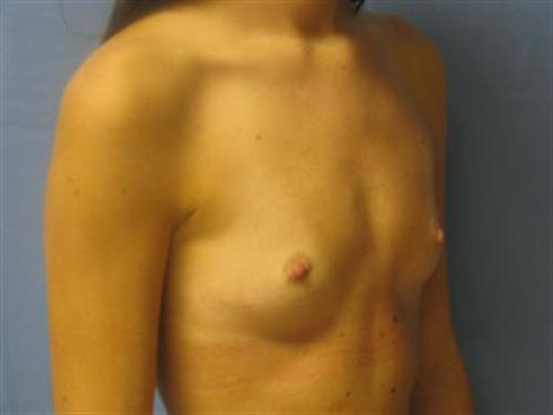 Breast Augmentation Before & After Gallery - Patient 260751 - Image 3