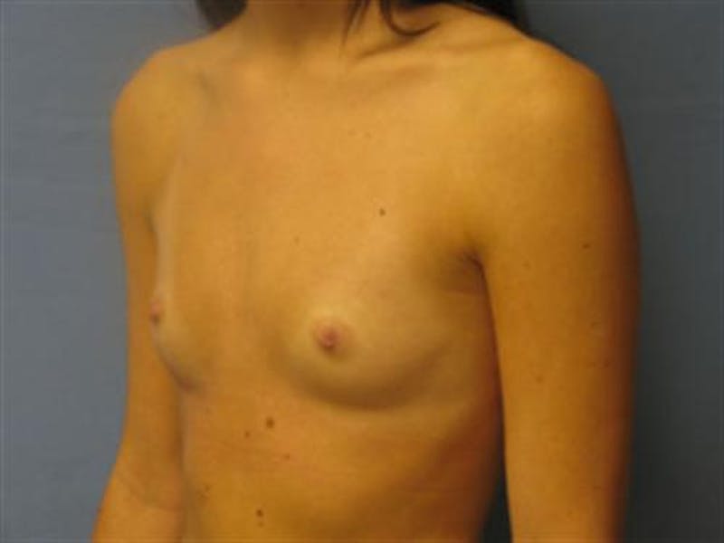Breast Augmentation Before & After Gallery - Patient 260751 - Image 5