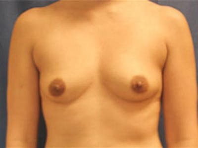 Breast Augmentation Before & After Gallery - Patient 388993 - Image 1