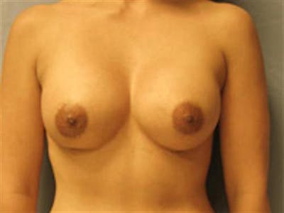 Breast Augmentation Before & After Gallery - Patient 388993 - Image 2