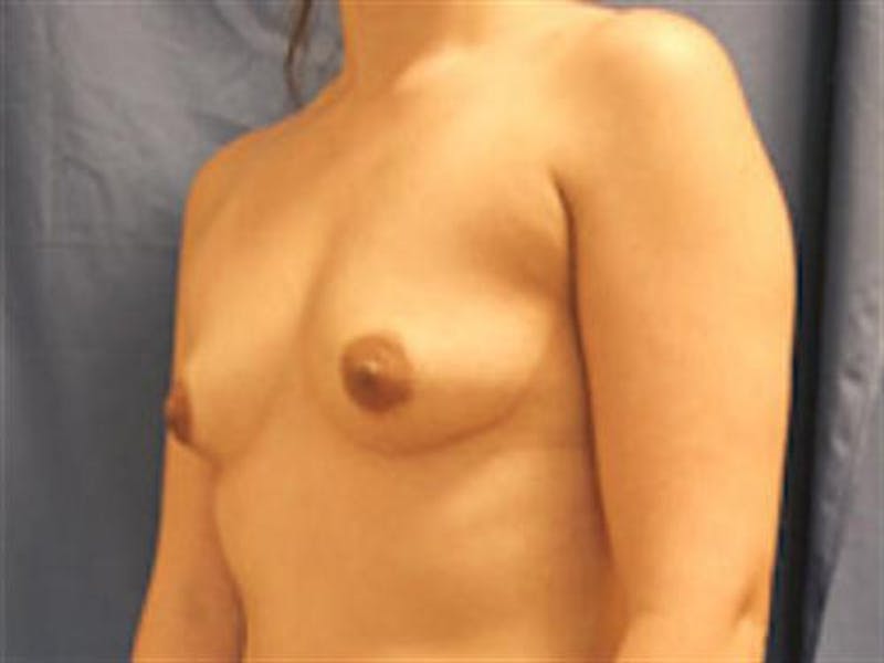 Breast Augmentation Before & After Gallery - Patient 388993 - Image 3