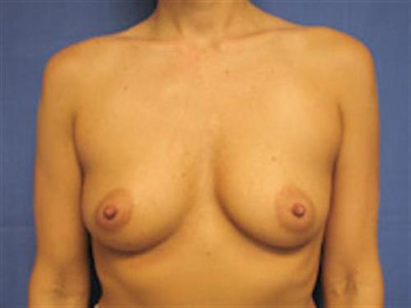 Breast Augmentation Before & After Gallery - Patient 160457 - Image 1