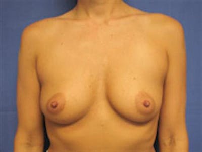 Breast Augmentation Before & After Gallery - Patient 160457 - Image 1