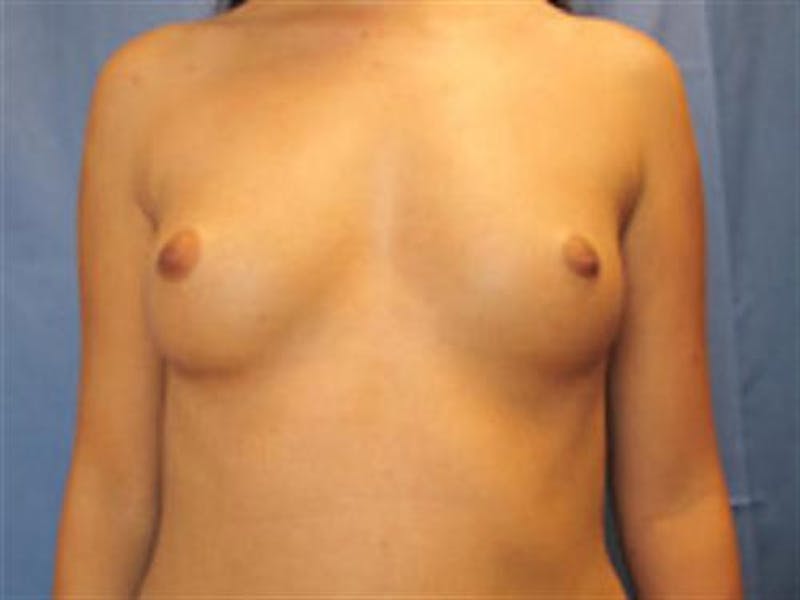 Breast Augmentation Before & After Gallery - Patient 238996 - Image 1