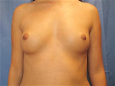 Breast Augmentation Before & After Gallery - Patient 238996 - Image 1