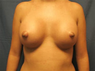 Breast Augmentation Before & After Gallery - Patient 238996 - Image 2