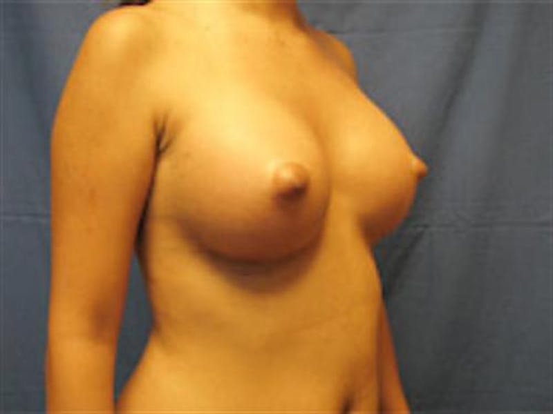 Breast Augmentation Before & After Gallery - Patient 238996 - Image 4