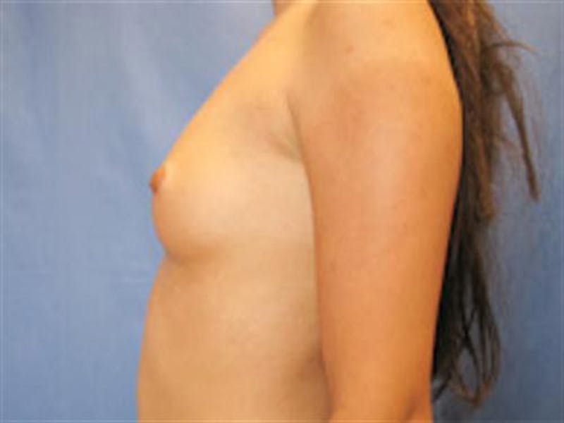 Breast Augmentation Before & After Gallery - Patient 238996 - Image 5