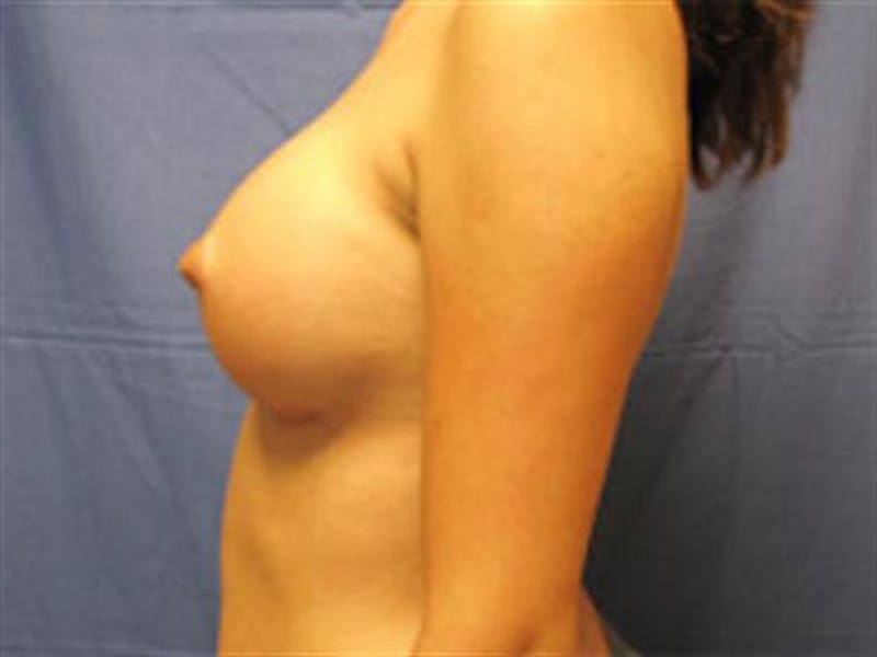 Breast Augmentation Before & After Gallery - Patient 238996 - Image 6
