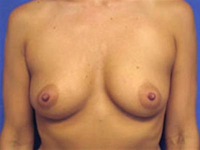 Breast Augmentation Before & After Gallery - Patient 408099 - Image 1