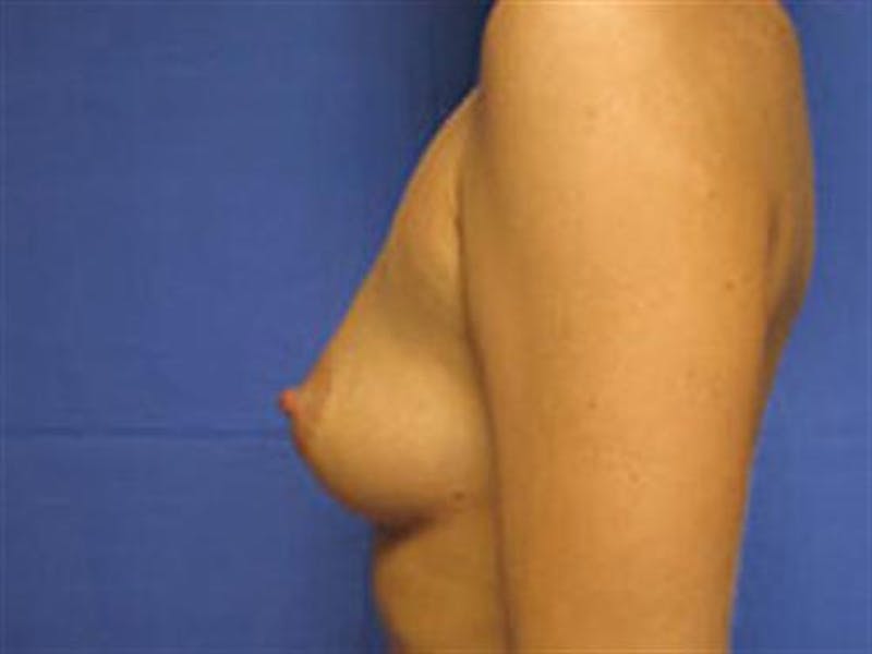Breast Augmentation Before & After Gallery - Patient 408099 - Image 3