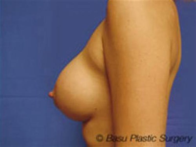 Breast Augmentation Before & After Gallery - Patient 408099 - Image 4