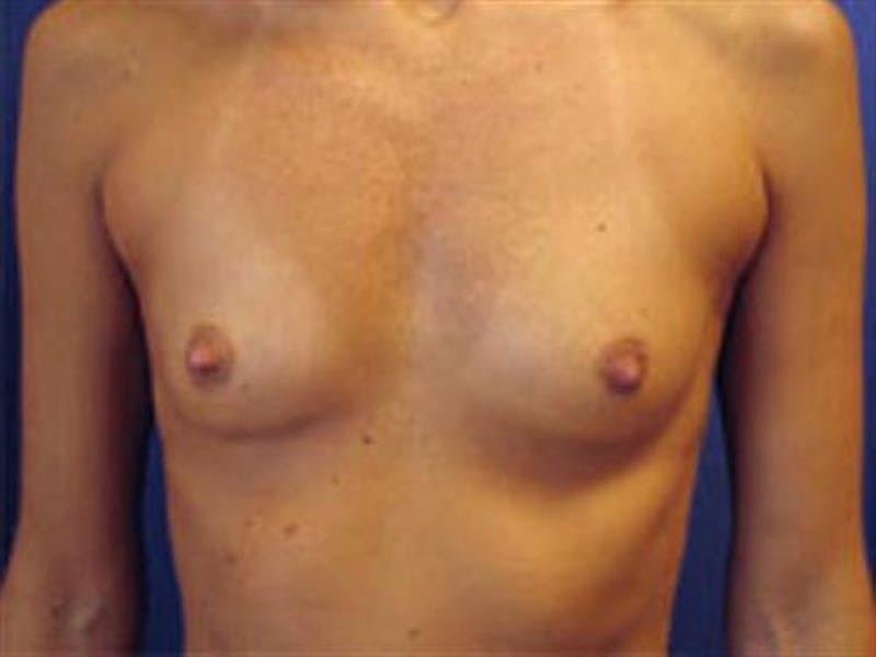 Breast Augmentation Before & After Gallery - Patient 394648 - Image 1