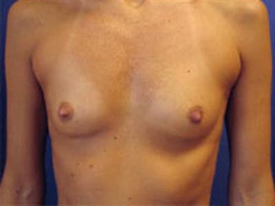 Breast Augmentation Before & After Gallery - Patient 394648 - Image 1