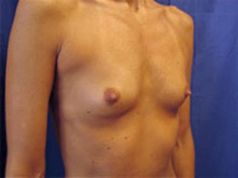 Breast Augmentation Before & After Gallery - Patient 394648 - Image 3