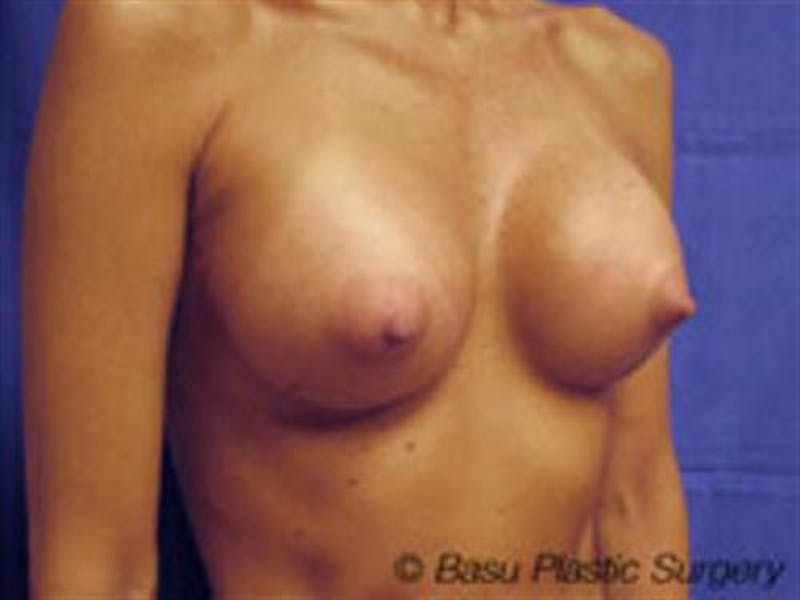 Breast Augmentation Before & After Gallery - Patient 394648 - Image 4