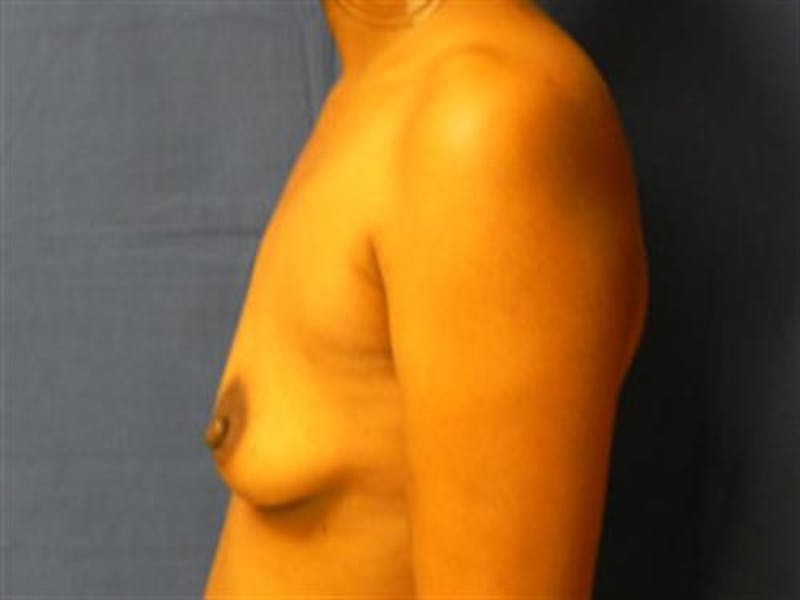 Breast Augmentation Before & After Gallery - Patient 342446 - Image 5