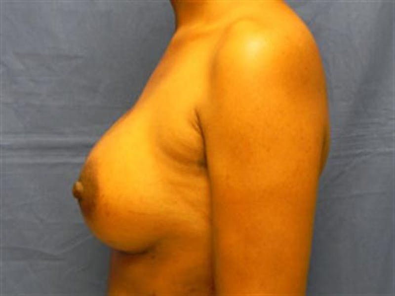 Breast Augmentation Before & After Gallery - Patient 342446 - Image 6