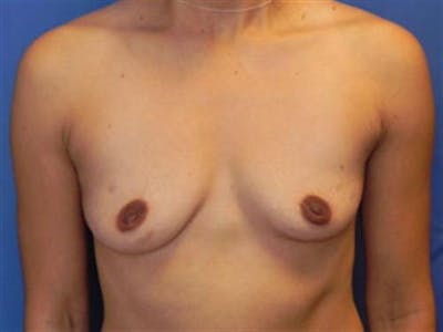 Breast Augmentation Before & After Gallery - Patient 587955 - Image 1