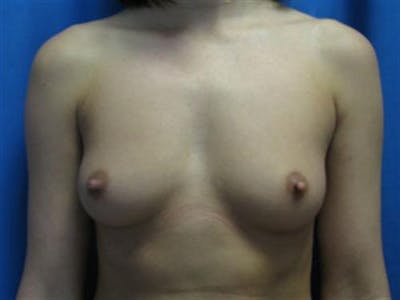Breast Augmentation Before & After Gallery - Patient 159395 - Image 1