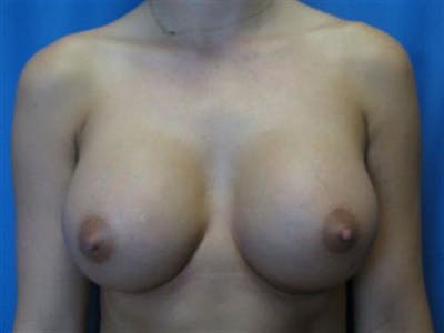 Breast Augmentation Before & After Gallery - Patient 159395 - Image 2