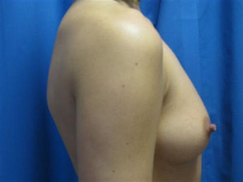 Breast Augmentation Before & After Gallery - Patient 159395 - Image 5