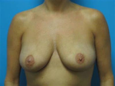 Breast Augmentation Before & After Gallery - Patient 448579 - Image 1